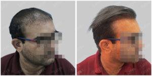 Men Hair Transplants: Satya hair Solutions