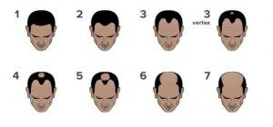 Male Pattern Baldness Treatment