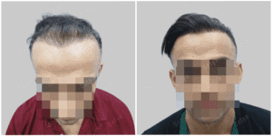 Men Hair Transplants: Satya hair Solutions