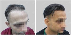 Men Hair Transplants: Satya hair Solutions