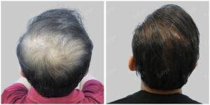Men Hair Transplants: Satya hair Solutions
