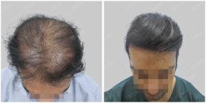 Men Hair Transplants: Satya hair Solutions
