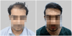 Men Hair Transplants: Satya hair Solutions