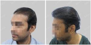 Men Hair Transplants: Satya hair Solutions