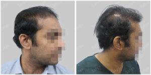 Men Hair Transplants: Satya hair Solutions