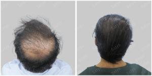 Men Hair Transplants: Satya hair Solutions