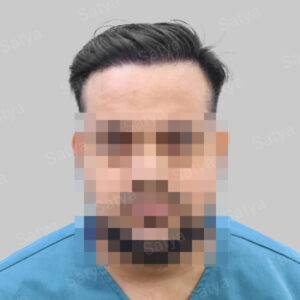 Hair Transplant Surgery Before and After Results Satya hair solutions