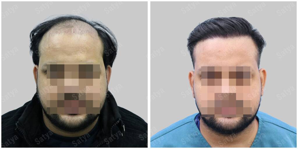 Men Hair Transplants: Satya hair Solutions