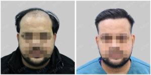 Men Hair Transplants: Satya hair Solutions