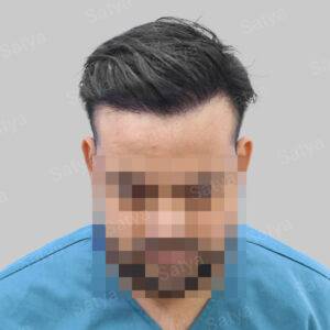 Hair Transplant Surgery Before and After Results Satya hair solutions