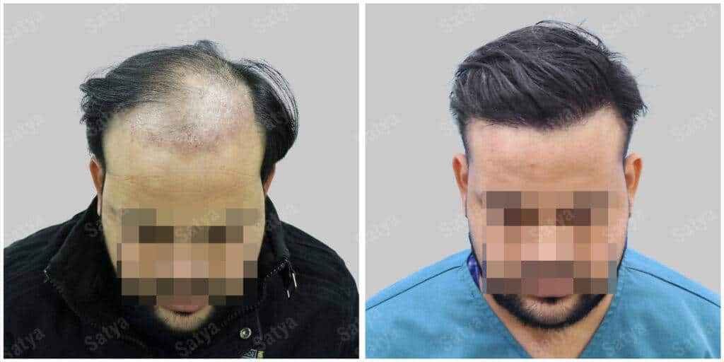 Men Hair Transplants: Satya hair Solutions