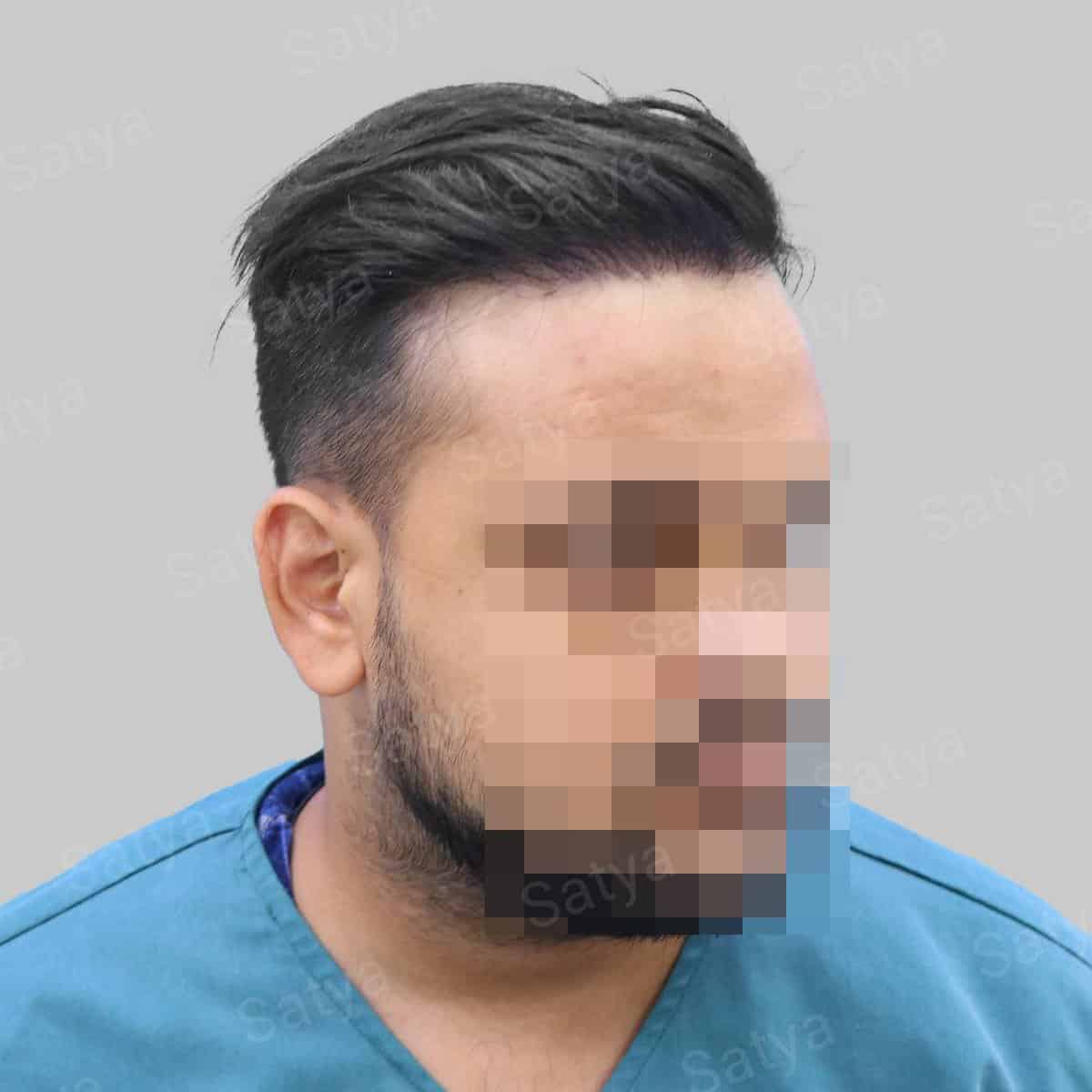 Hair Transplant Surgery Before and After Results Satya hair solutions