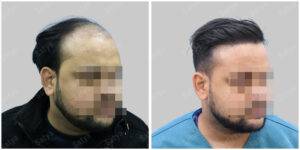 Men Hair Transplants: Satya hair Solutions