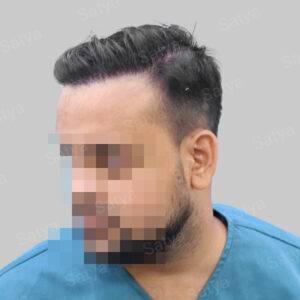 Hair Transplant Surgery Before and After Results Satya hair solutions
