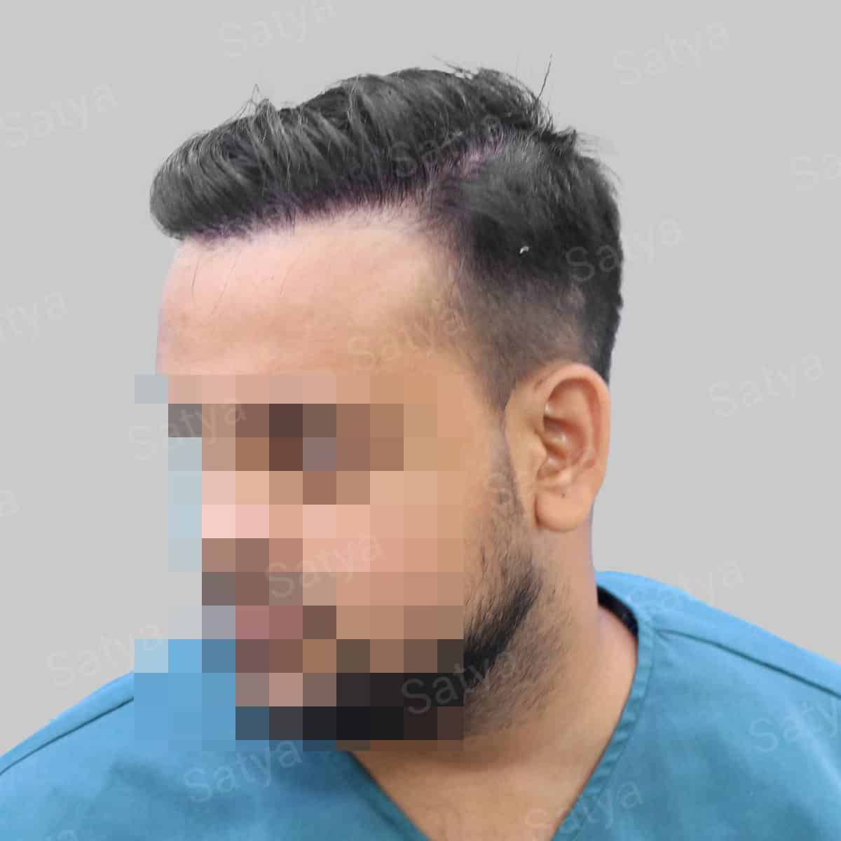 Hair Transplant Surgery Before and After Results Satya hair solutions