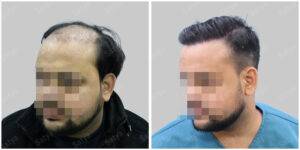 Men Hair Transplants: Satya hair Solutions