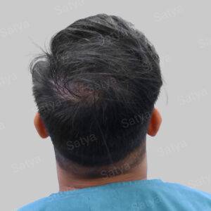 Hair Transplant Surgery Before and After Results Satya hair solutions