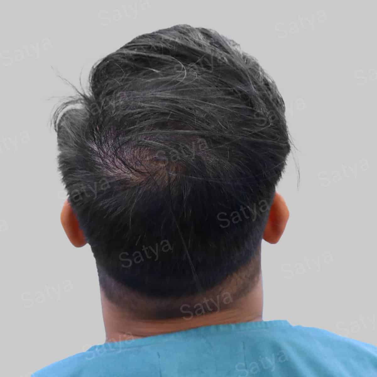 Hair Transplant Surgery Before and After Results Satya hair solutions