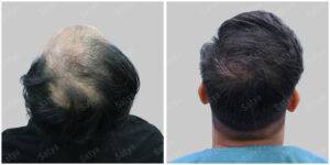 Men Hair Transplants: Satya hair Solutions