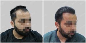 Men Hair Transplants: Satya hair Solutions