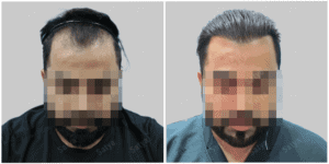 Men Hair Transplants: Satya hair Solutions