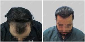 Men Hair Transplants: Satya hair Solutions