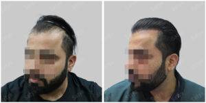 Men Hair Transplants: Satya hair Solutions