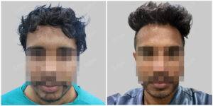 hair transplant before and after in delhi
