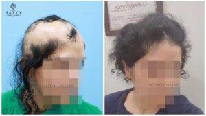 female hair transplant surgery