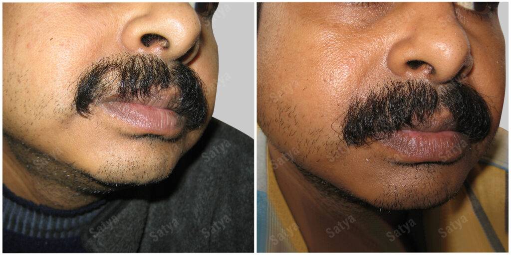 mustache hair transplant
