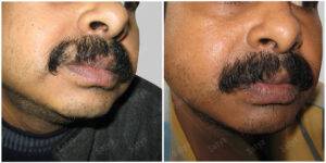 mustache hair transplant