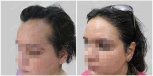 female hair transplant | Satya hair solutions