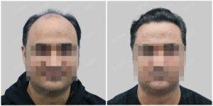 Men Hair Transplants before and after | Satya Hair Solutions
