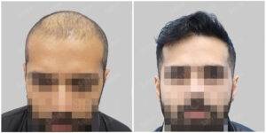 Men Hair Transplants before and after | Satya Hair Solutions