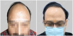 Men Hair Transplants before and after | Satya Hair Solutions