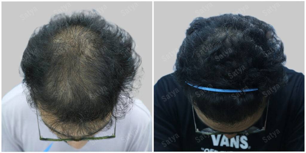 Men Hair Transplants | Satya Hair Solutions