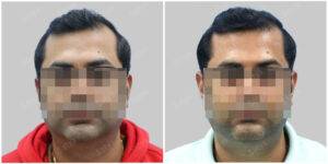 Men Hair Transplants | Satya Hair Solutions