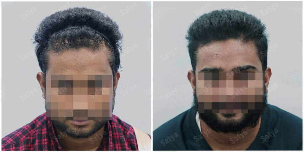 Men Hair Transplants | Satya Hair Solutions