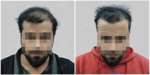 Hair Transplant Before and After Results | Satya hair Solutions