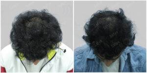 Hair Transplant Before and After Results | Satya hair Solutions