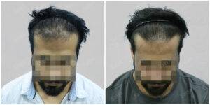 Hair Transplant Before and After Results | Satya hair Solutions