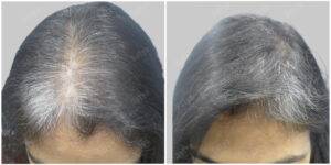 Female Hair Transplant | Women Hair Transplant Cost in India