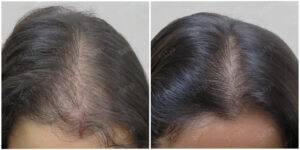 female hair results before and after