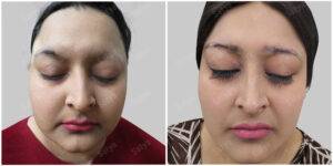 female facial - Satya hair solutions