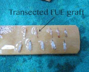 Difference Between FUT & FUE Hair Transplant