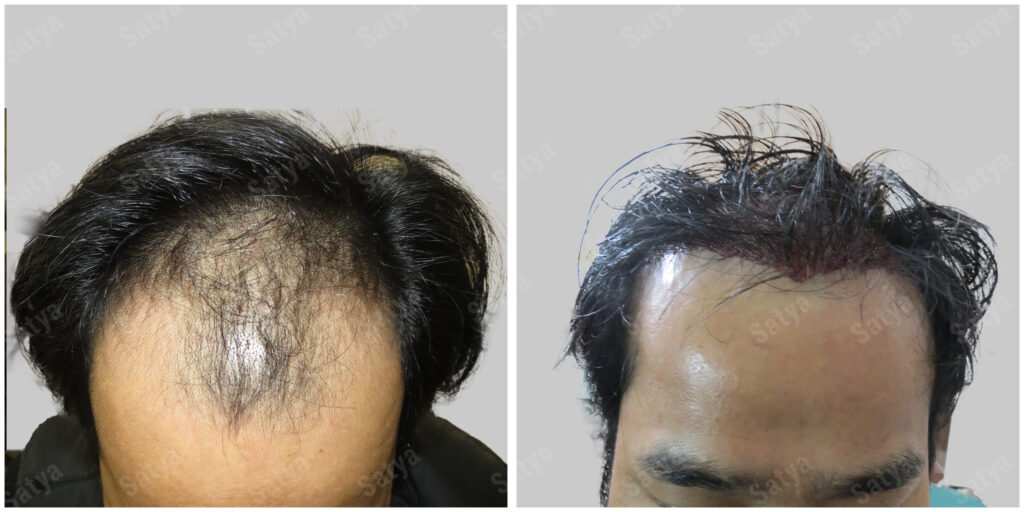 hair transplant