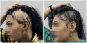 female hair transplant