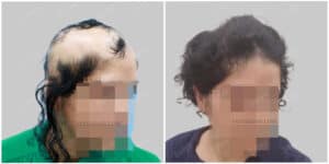 female hair transplant