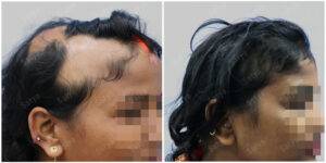female hair transplant