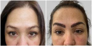 eyebrow restoration